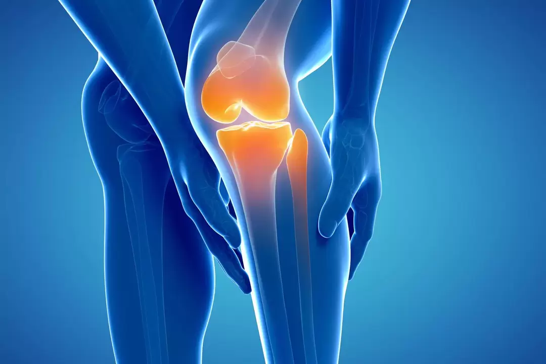 Artroza e kyçit të gjurit (gonartroza, osteoartriti deformues)