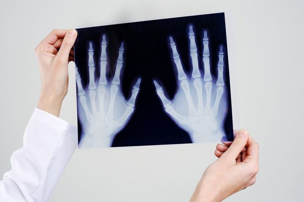 Diagnostifikimi i nyjeve të dorës