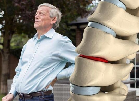 Osteokondroza prek disqet ndërvertebrale dhe shkakton dhimbje shpine