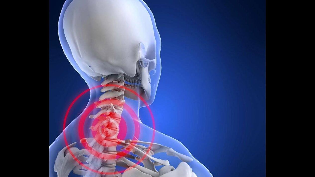 Osteokondroza e shpinës së qafës së mitrës